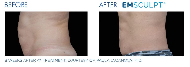 before-and-after-emsculpt-used